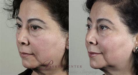 Nonsurgical Face Procedures Before And After Pictures Case 308