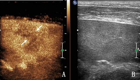 Frontiers The Role Of Contrast Enhanced Ultrasound In Differentiating