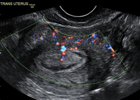 Wk 3 L2 Endometrial Polyp With Coronal Us Reformat Radiology Case