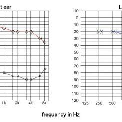 Sensorineural hearing loss can be inherited (genetic hearing loss) and finally you may lose your hearing ability due to head/ear injuries. Pure tone audiogram: Mild bilateral sensorineural hearing ...