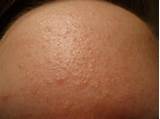 Photos of Sandpaper Acne Treatment