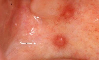You may have experienced them before on your tongue, lips, or the back of your throat. Bump on Roof of Mouth-Hurts, Hard, Small, Sinus Infection, Red, White, When Eating