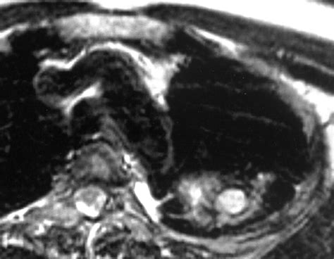 Intrapulmonary Bronchogenic Cyst Ct And Pathologic Findings In Five Adult Patients Ajr