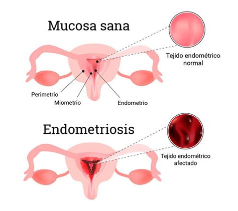 Endometriosis Qu Es Y Qu Lesiones Provoca