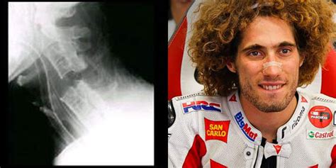Marco simoncelli, pembalap motogp asal italia, menyerah setelah cedera parah menimpanya. Unique: The results of X-ray Rider Marco Simoncelli
