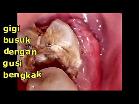Penyakit Gigi Berlubang - Gejala, Penyebab, Pengobatan ...