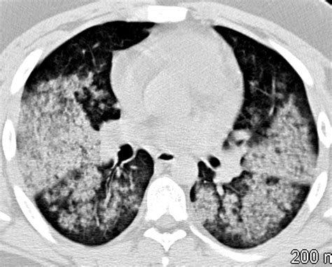 Wegeners Granulomatosis With Polyangiitis Gpa Lungs