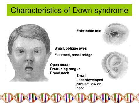 A genetic disorder, it occurs because of the presence of an extra chromosome. Brett Caton's Controversial Commentary: Has Squirrel Girl acquired Down's Syndrome as a mutation?