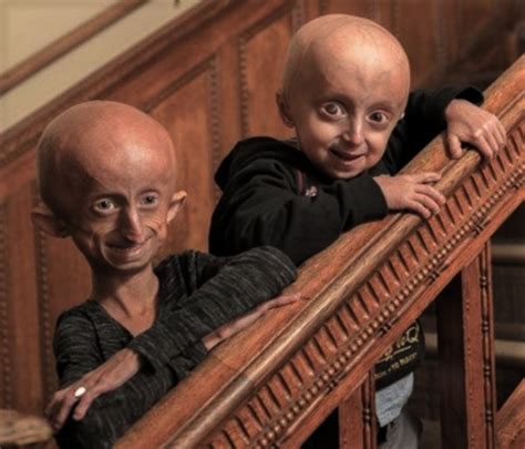 โรคชราในเด็ก Hutchinson Gilford Progeria Syndrome