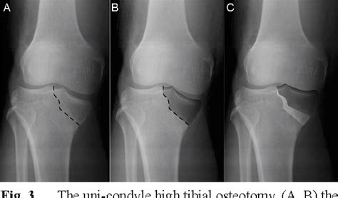 Pdf Uni Condyle High Tibial Osteotomy For Malunion Of Medial Plateau