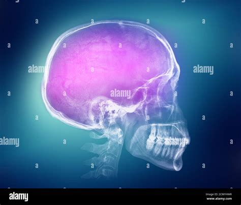 Human Skull X Ray Image Stock Photo Alamy