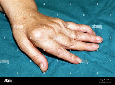 A Photograph Of Severe Rheumatoid Arthritis Affecting The Hand Stock