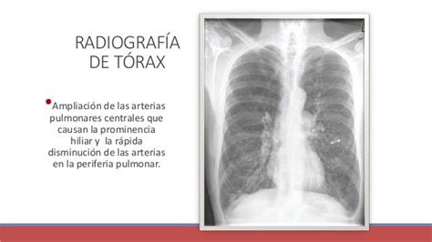 Cor Pulmonale Crónico