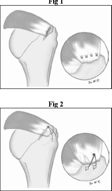 Figure 2 From Arthroscopic Single Row Versus Double Row Rotator Cuff
