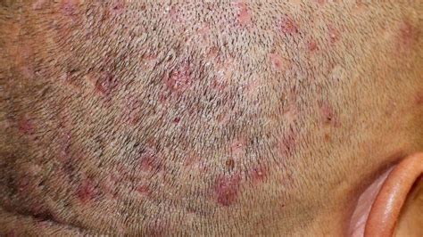 Scabs On Scalp Everything You Need To Know Wimpole Clinic