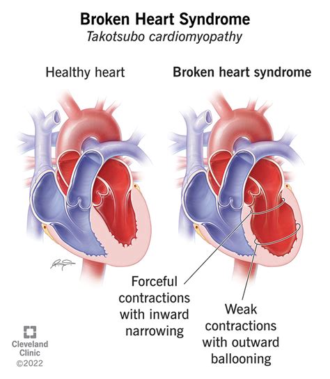 Broken Heart Syndrome Symptoms And Causes