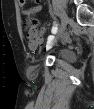 De Garengeot Hernia Radiology Reference Article Radiopaedia Org