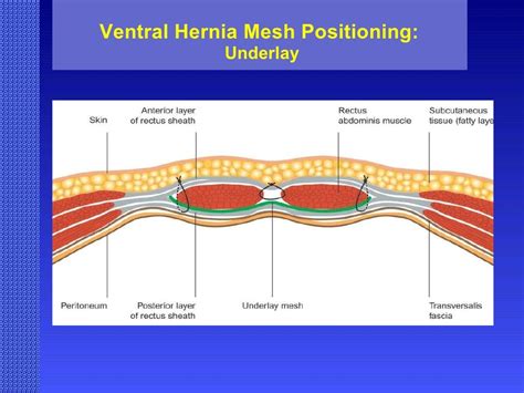 What Type Of Doctor To See For A Ventral Hernia