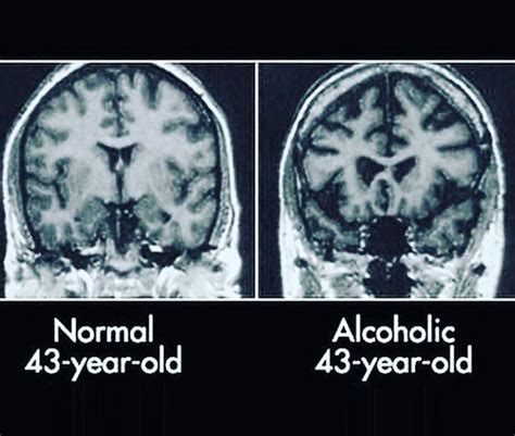 Normal Vs Alcoholic Brain Medizzy