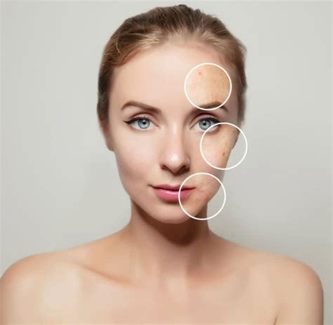 Kobayashi Acne Treatment - Theme Dermatology