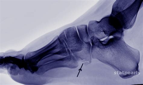 Figure Cuboid Fracture Image Courtesy S Bhimji Md Statpearls