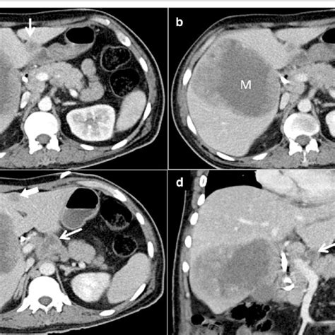 Contrast Enhanced Abdominal Computed Tomography Images Acquired 1 Month