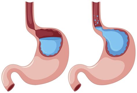 All You Need To Know About GERD Smiles Gastroenterology