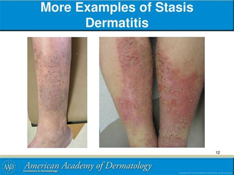 Ppt Stasis Dermatitis And Leg Ulcers Powerpoint Presentation Free