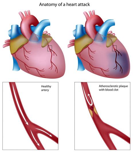 What Is An St Elevation Myocardial Infarction With Pictures