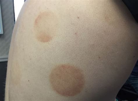 Derm Dx Circular Ecchymotic Lesions On The Back Dermatology Advisor