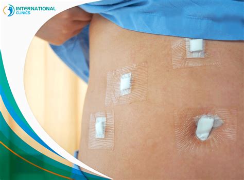 Gastric Sleeve Incisions What You Need To Know International