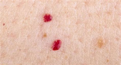 Red Dots On Skin Causes And Expert Solutions