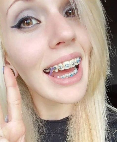 Braces Braceface Metalbraces Girlswithbraces Elastics Dental Braces Cute Braces Teeth