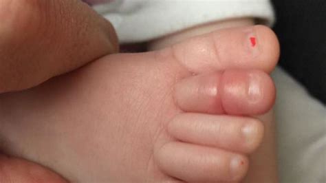 Hair Tourniquet Dad Shares Photo Of Babys Swollen Toe To Warn Parents
