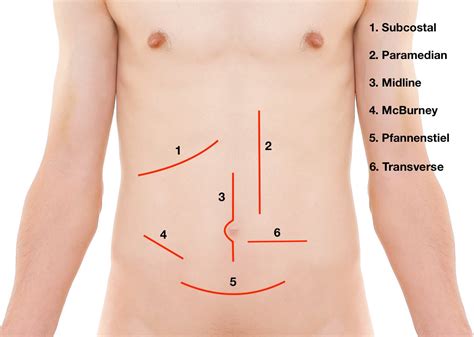 Operative Steps Of Management Of Paraumbilical Hernia During Cesarean