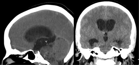 Ct Sagittal Left And Coronal Right Images Depict An Hydrocephalus