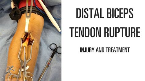distal biceps tendon