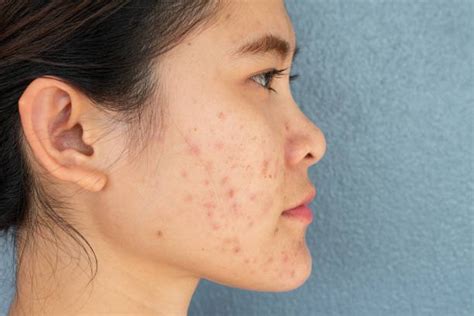 Acne Marks Vs Acne Scars Whats The Difference Image Clinic