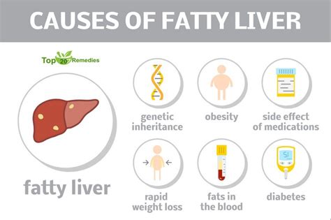 causes of fatty liver | Fatty liver, Liver disease, Fatty liver treatment