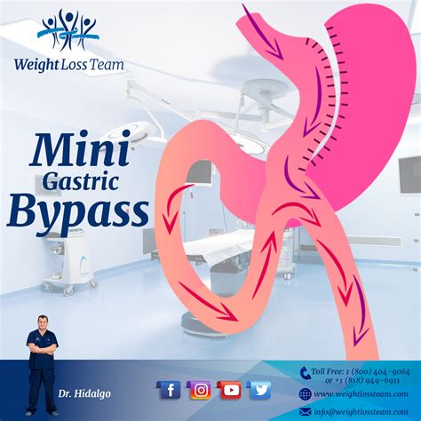 Mini Gastric Bypass What Is The Mini Gastric Bypass Procedure