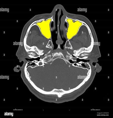 Paranasal Sinus Anatomy CT Scan Stock Photo Alamy