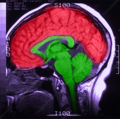 Mri Of Normal Brain Stock Image C0271013 Science Photo Library