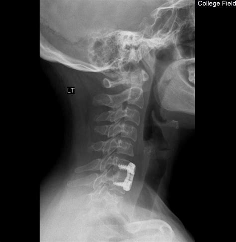 Cervical Spinal Fusion Acdf 6 Weeks Post Op Xray Of Titanium Plate And