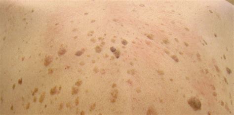 Seborrheic Keratosis Pictures