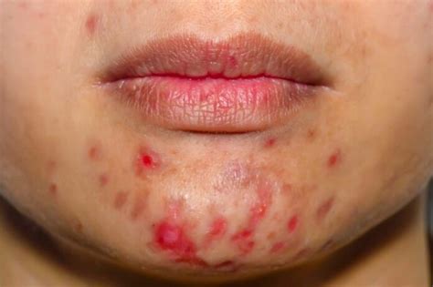 How To Treat Different Types Of Acne Causes Symptoms