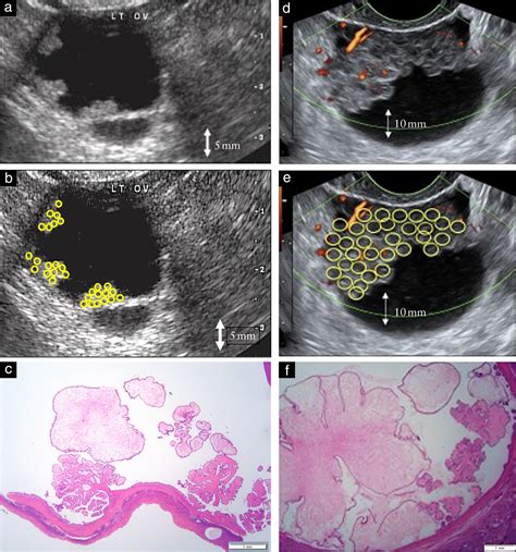 New Sonographic Marker Of Borderline Ovarian Tumor Microcystic Pattern