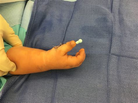 Extra Thumb Reconstruction Congenital Hand And Arm Differences