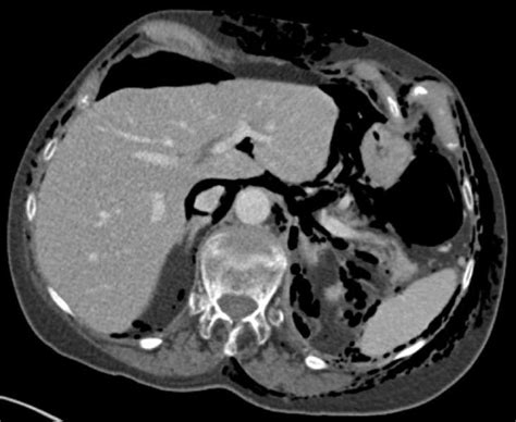 Mistakes In Acute Abdominal Ct And How To Avoid Them Ueg United