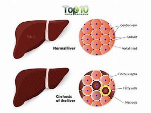 What 2 Cups of Coffee per Day Can Do for Your Liver - Top 10 Home Remedies Cirrhosis  