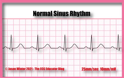 Ecg Educator Blog Normal Sinus Rhythm